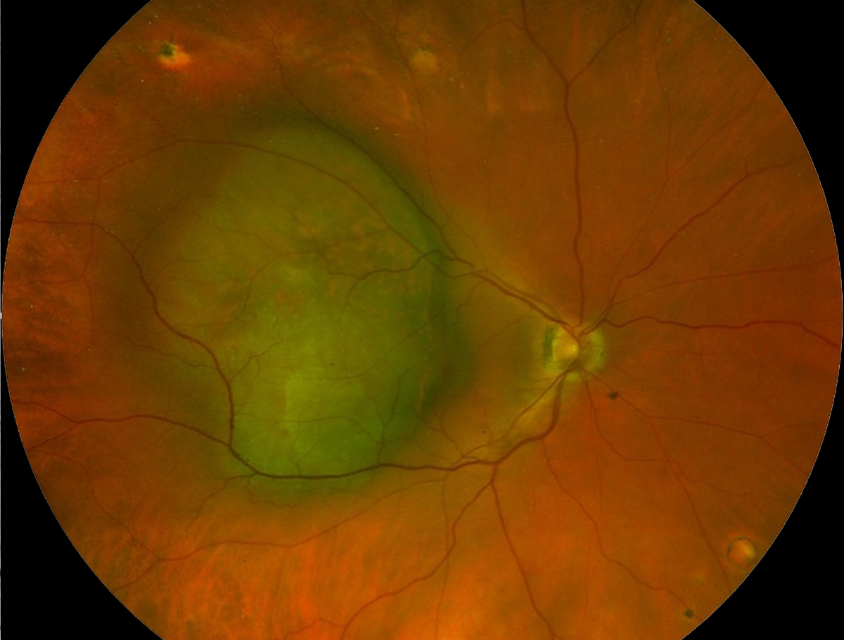 Choroidal melanoma