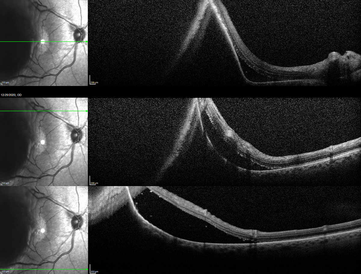 Choroidal melanoma