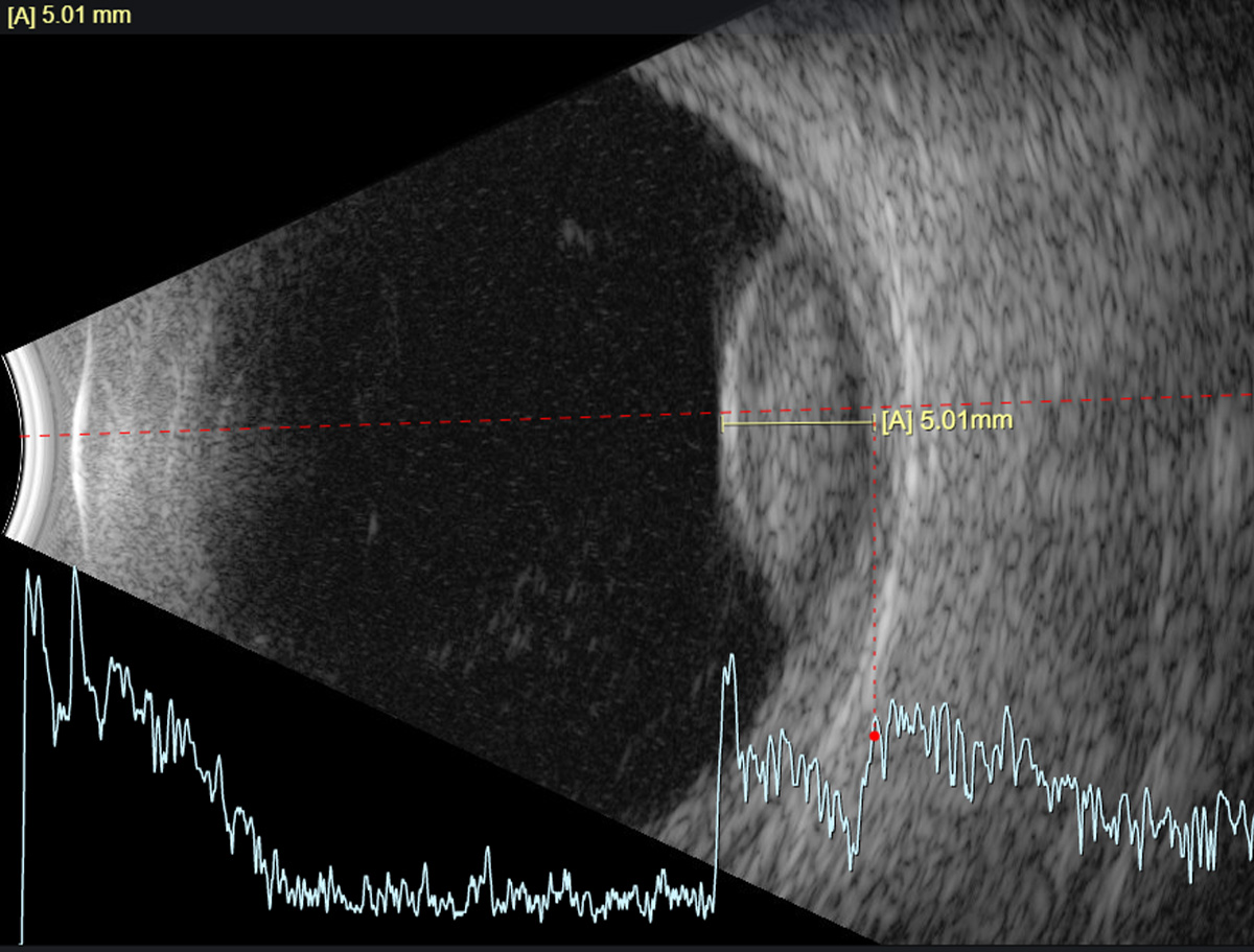 Choroidal melanoma