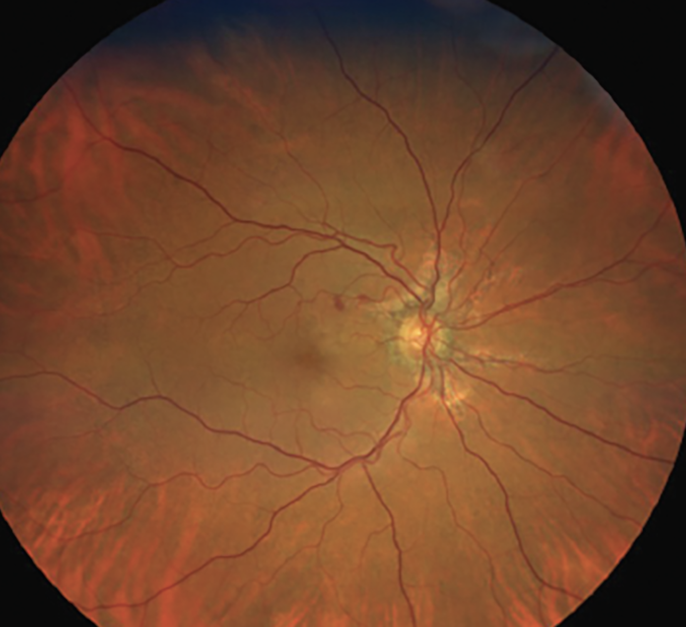 Angioid streaks associated with PXE.