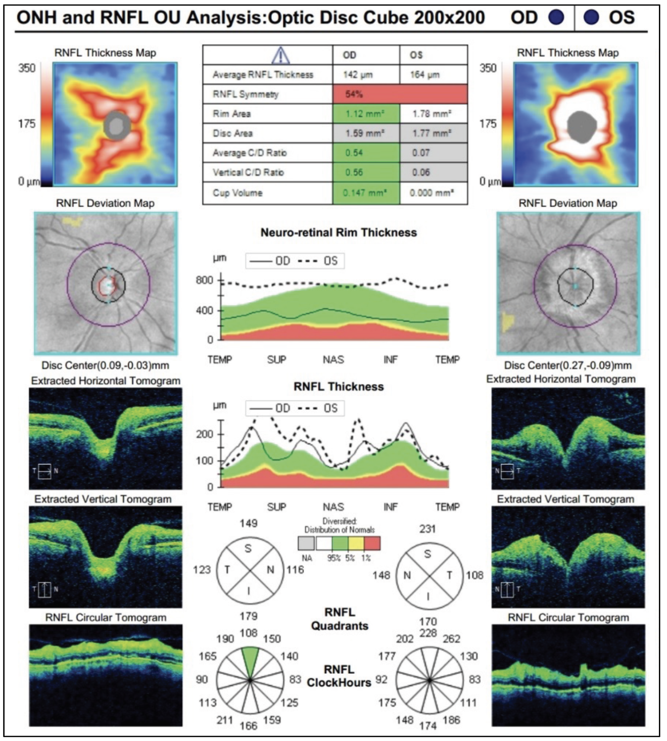 Fig. 3. OCT RNFL revealed thickening circumferentially, greater in the left eye than in the right.