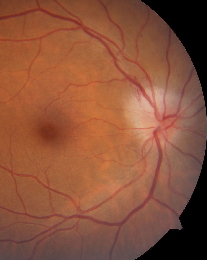 Tyrosine-kinase inhibitors, used to treat a form of leukemia, can induce fluid retention and periorbital edema by decreasing interstitial pressure and increasing transcapillary fluid transport. Conceivably, the mechanism through which edema occurs may extend to the optic nerve tissue, the authors speculate, leading to optic neuritis.