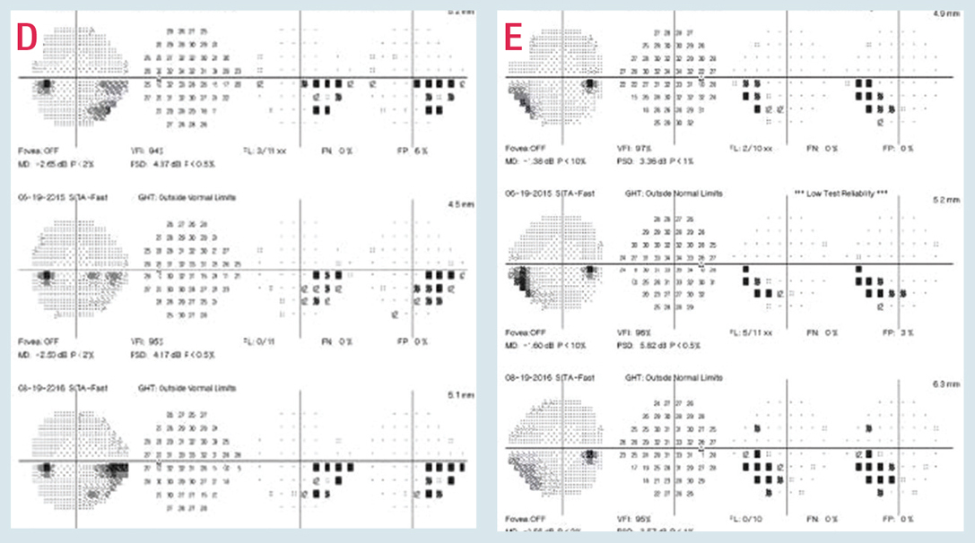 Visual field progression is most likely to progress in patients with ocular hypertension in the nasal and paracentral regions of the optic disc, and treatment may slow the rate, according to a new study.