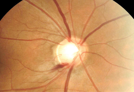 Subjects with larger disc hemorrhages showed faster global mean deviation loss in this study.