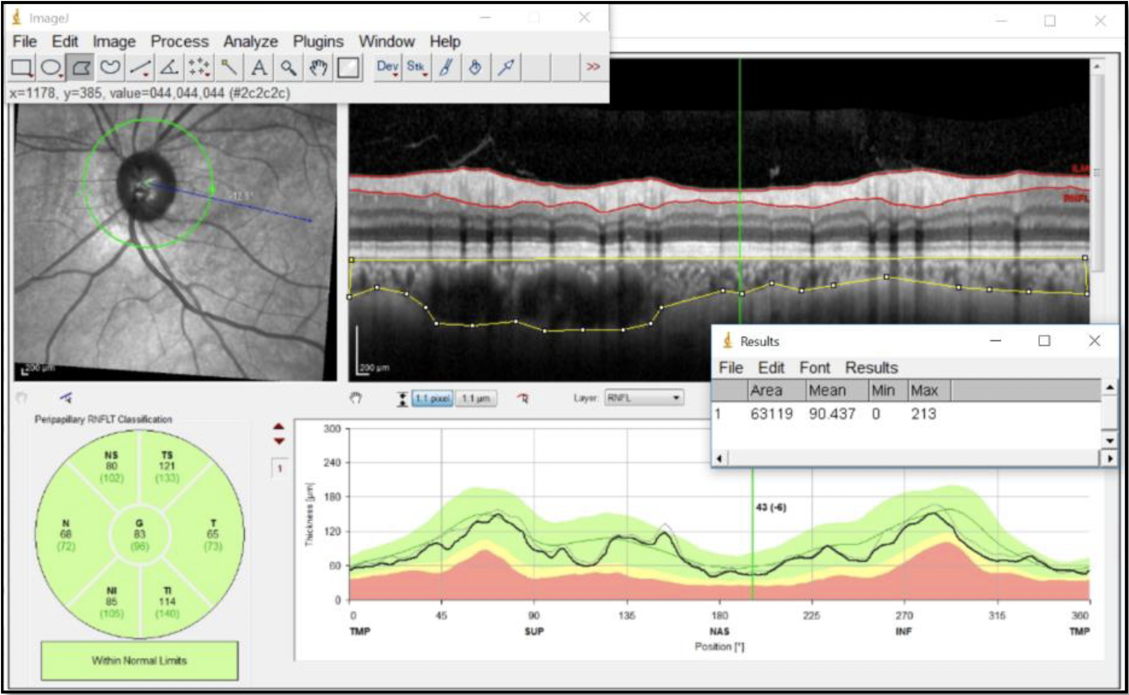 This analysis, including nearly 1,000 patients, is the first to compare PPCT in normal-tension glaucoma vs. primary open-angle glaucoma, finding that the latter was reduced with a mean difference of -26.64.