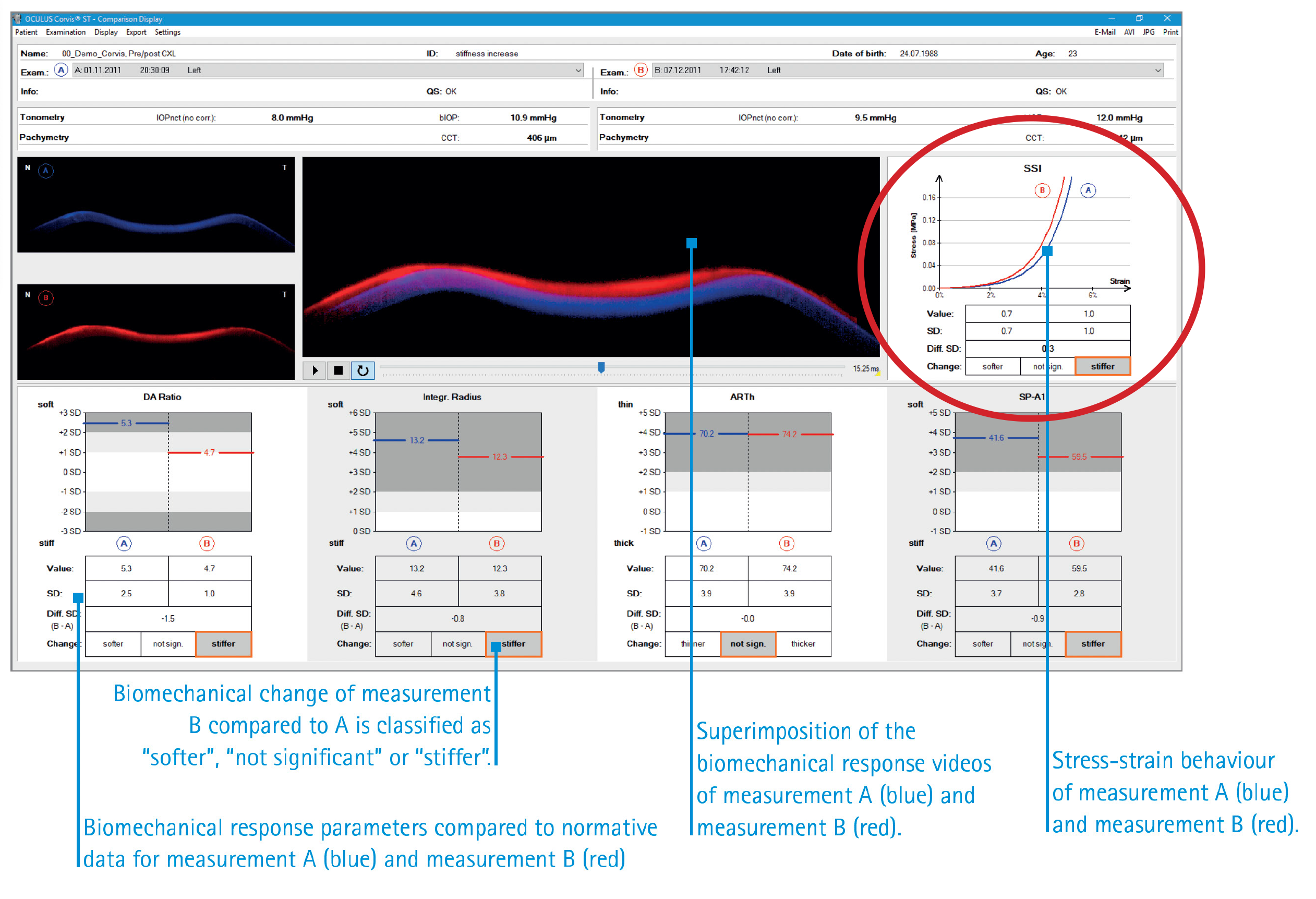 The association between the stress-strain index and RNFL thickness was significant in the non-high myopic group but not in the highly myopic group.