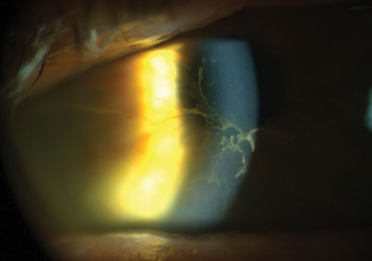 Fig. 5. Paralellepiped illumination is most useful when focusing on specific features of the eye.