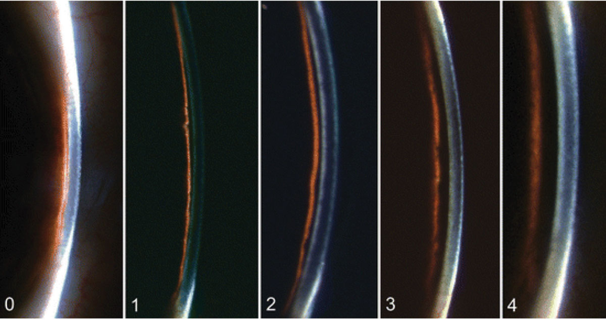 Fig. 7. The Van Herick method assesses the depth of the anterior chamber in relation to the thickness of the cornea from grades 0 to 4, as pictured here.