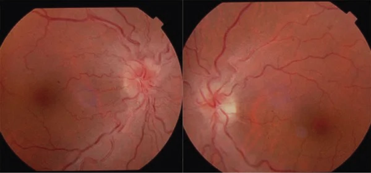 Fig. 9. Leber’s hereditary optic neuropathy.