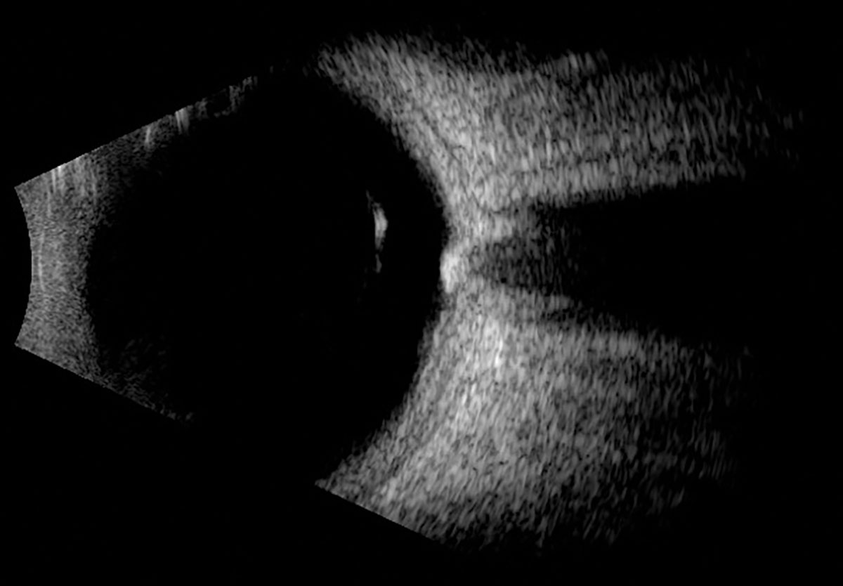 Fig. 2. Horizontal axial B-scan of the left globe.