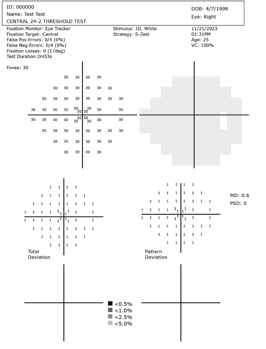 Healthy right eye visual field example for reference. These test results are from an unaffected 26-year-old using an HMD. Testing time was 2m 53s.