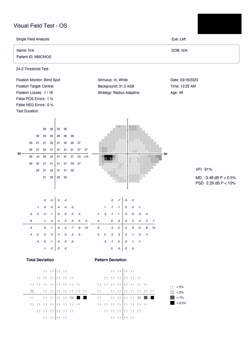 Head-mounted device example with early glaucoma defect. This was a 49-year-old glaucoma patient with an inferior nasal step in the left eye as detected by the HMD.