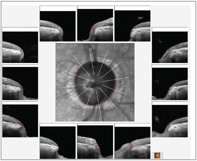 Fig. 1. Bruch’s membrane opening minimum rim width (BMO-MRW) overview of the right neuroretinal rim. Note the eroded temporal rim, along with notching of the inferotemporal segment.