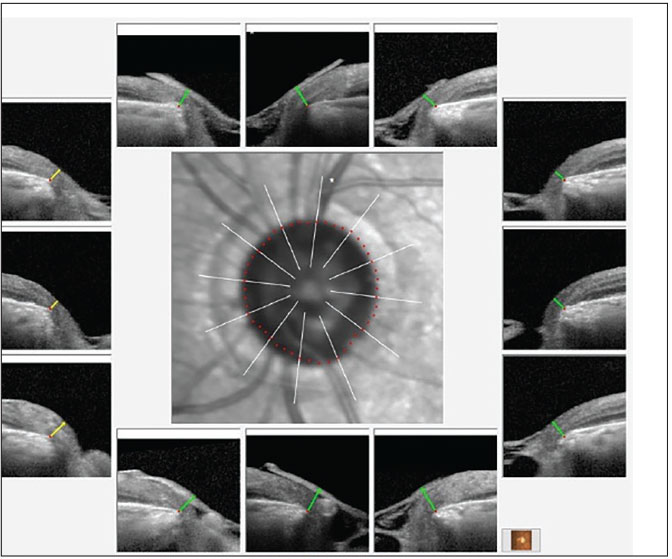 Fig. 2. BMO-MRW overview of the left neuroretinal rim. Note the overall thin neuroretinal rim, but with the remaining rim still adequate for relatively good visual field levels.