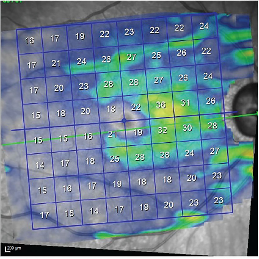 Fig. 3. Ganglion cell thickness OD demonstrates loss of ganglion cells consistent with the visual field loss present in this eye, which involves fixation.