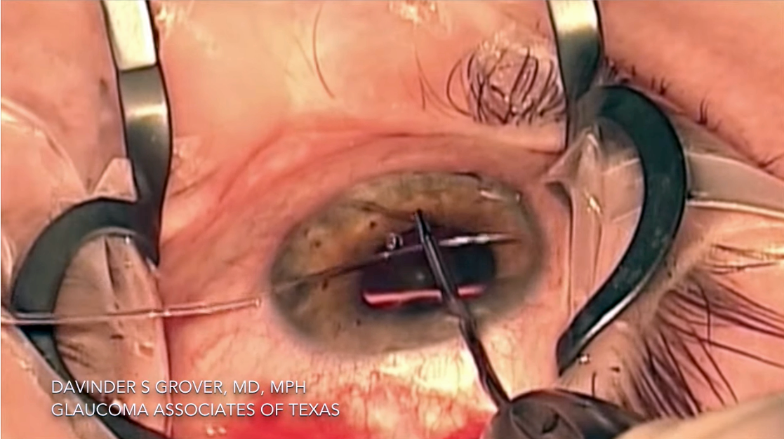 Disease stage was not a factor in the IOP-lowering efficacy of GATT in this study, as patients mild, moderate and advanced glaucoma all benefited.