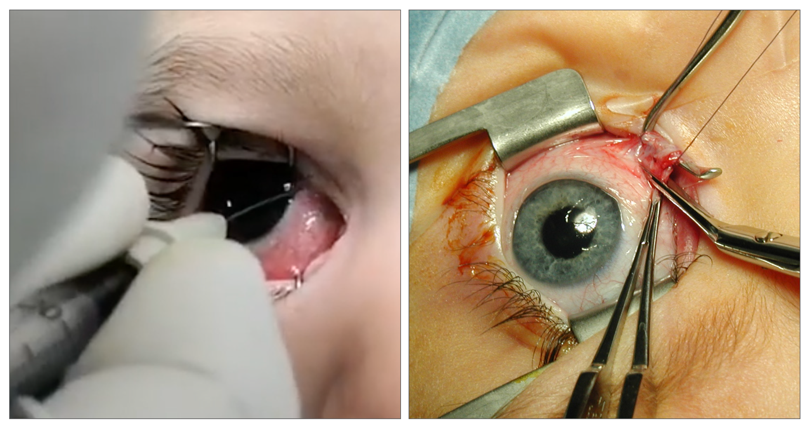 Longer delays from esotropia onset to treatment and the presence of amblyopia were independent risk factors for worse sensorimotor outcomes in patients with acute, comitant esotropia.