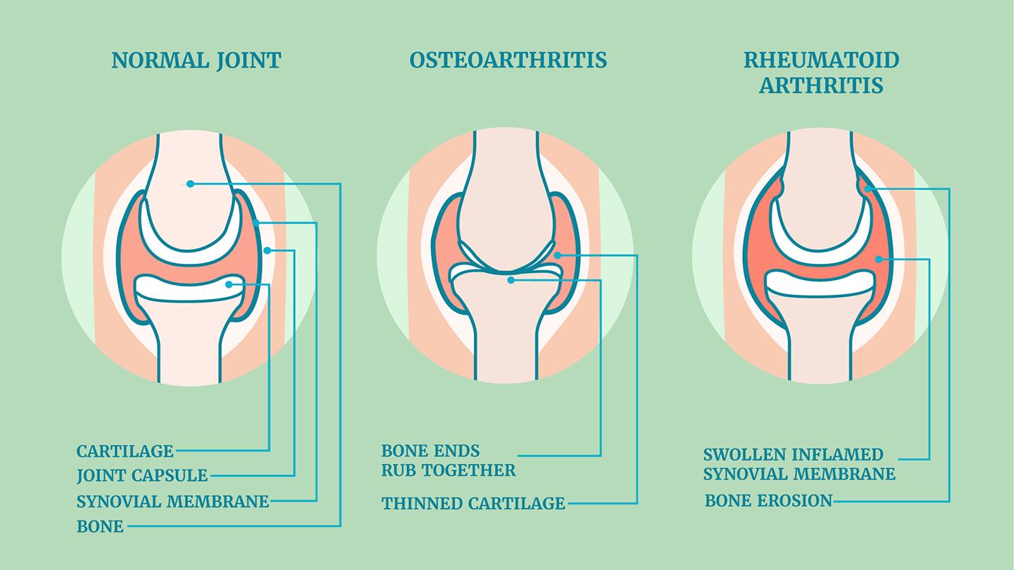 No causal effect of RA on glaucoma was found in the East Asian population, but there was a positive association between RA and glaucoma in the European population.