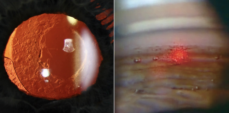 South Dakota’s scope win brings the number of laser states up to 12 for the optometry profession. YAG capsulotomy and SLT are allowed there, plus three injection procedures and IPL.