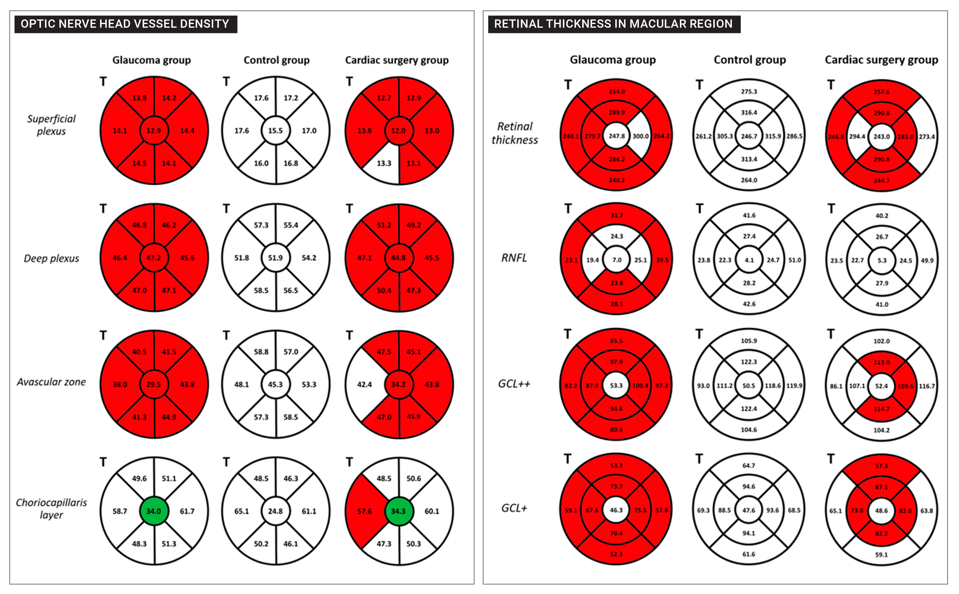 Cardiac surgery patients had lower vascular and structural parameters in the optic nerve hypoplasia and macula compared to healthy controls that were similar to patients with OAG.