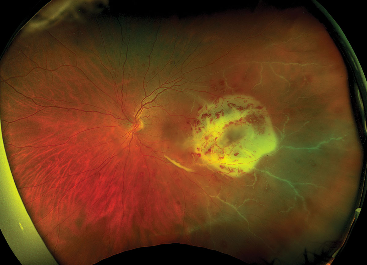 Higher rates of vitrectomies were seen in the South and Midwest regions compared to the Northeast and West for patients presenting with endophthalmitis.