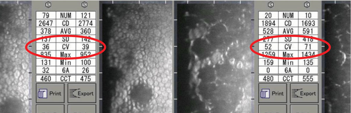 Associations between corneal and anterior chamber morphological parameters on anterior segment imaging in healthy individuals helps reveal potential threats of myopia on endothelial cells.