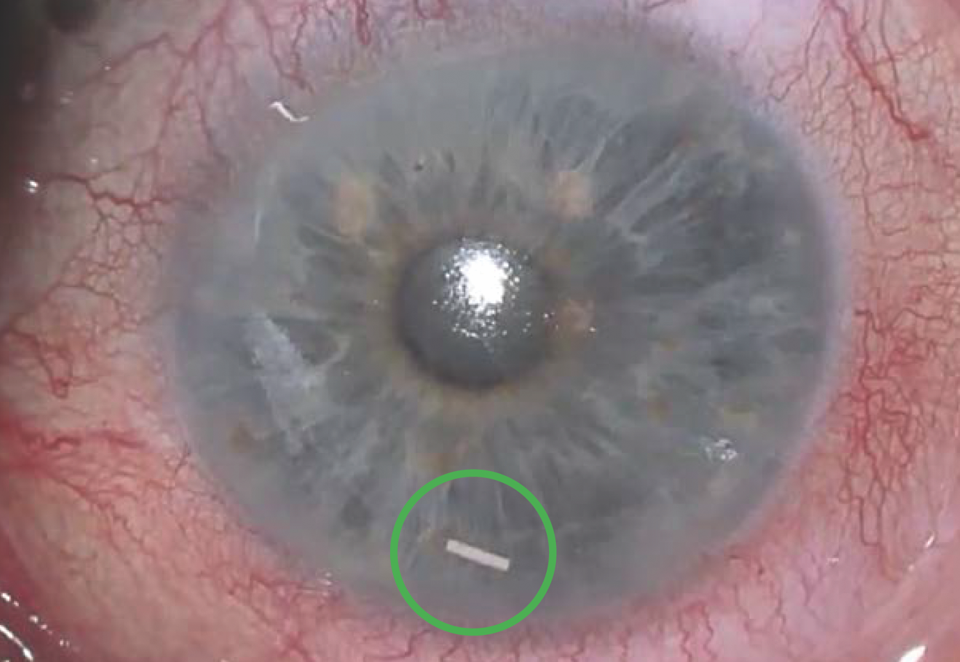 Researchers at Duke University examined the effect of the bimatoprost sustained release implant on the number of IOP-lowering medications needed by patients with glaucoma and found a significant decrease in those with mild/moderate disease up to six months, but only at one month in those with severe disease. 