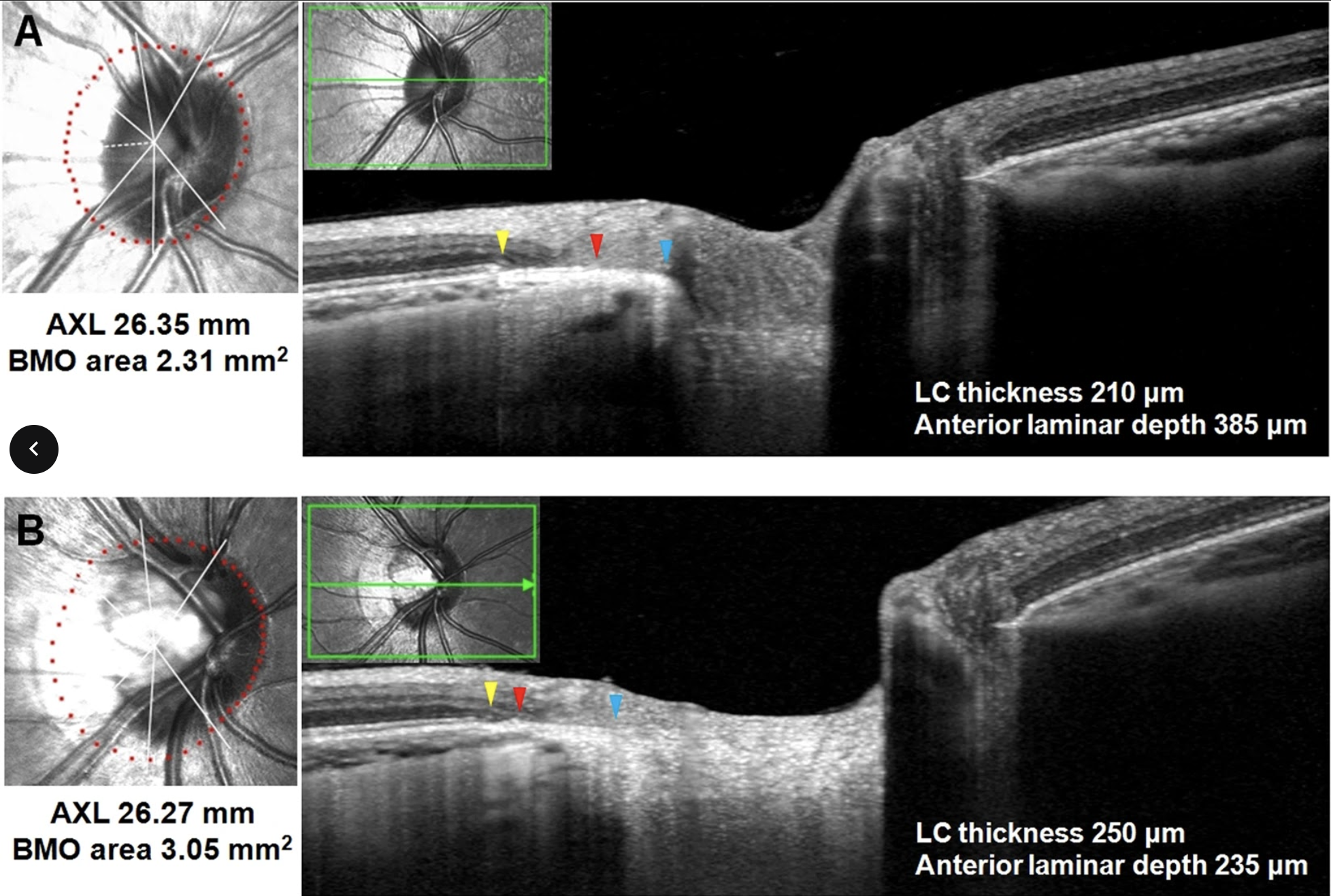 A marked change of peripapillary structures, including border tissue, Bruch’s membrane, choroid and sclera, could be observed not only in adult eyes with high myopia but also in those with moderate myopia to a lesser extent. These images, from a different study, show myopic eyes with similar axial length but different presentations of peripapillary changes indicative of high myopia.