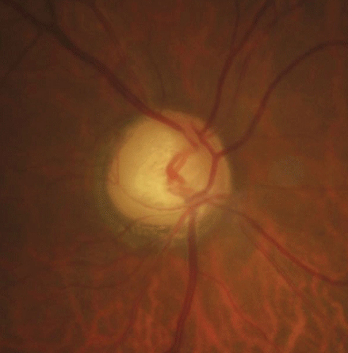 There was a significant positive correlation between BMI percentile and Goldmann-correlated IOP, as well as with corneal hysteresis and corneal resistance factor values.