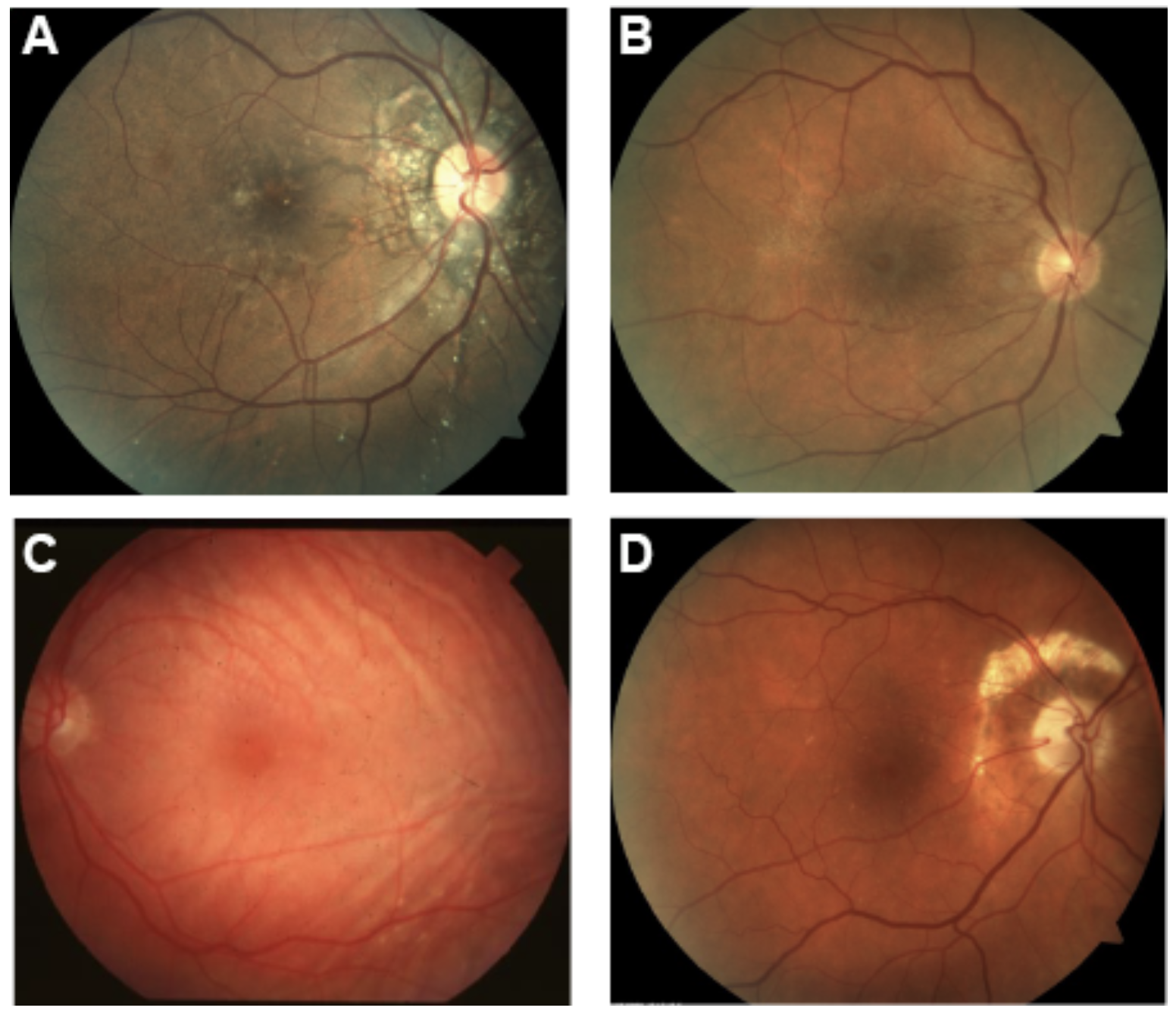 Which of the following images represents angioid streaks?