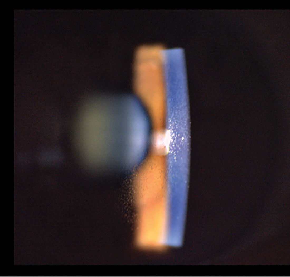 Paracentral non-confluent MECs.