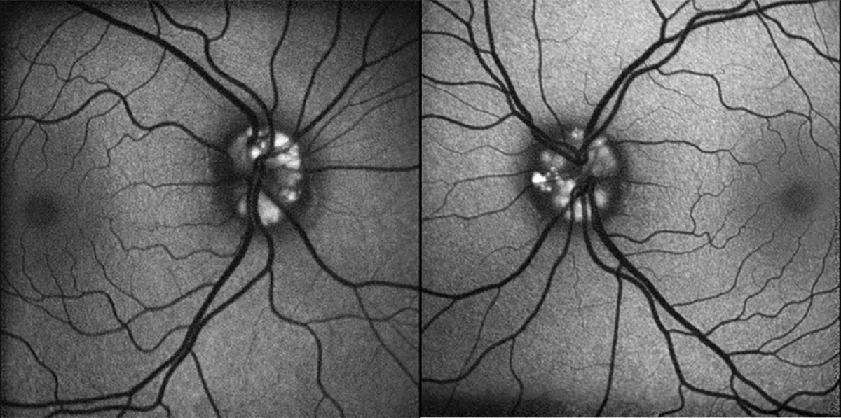 Fig. 3. FAF of OD (left) and OS (right).