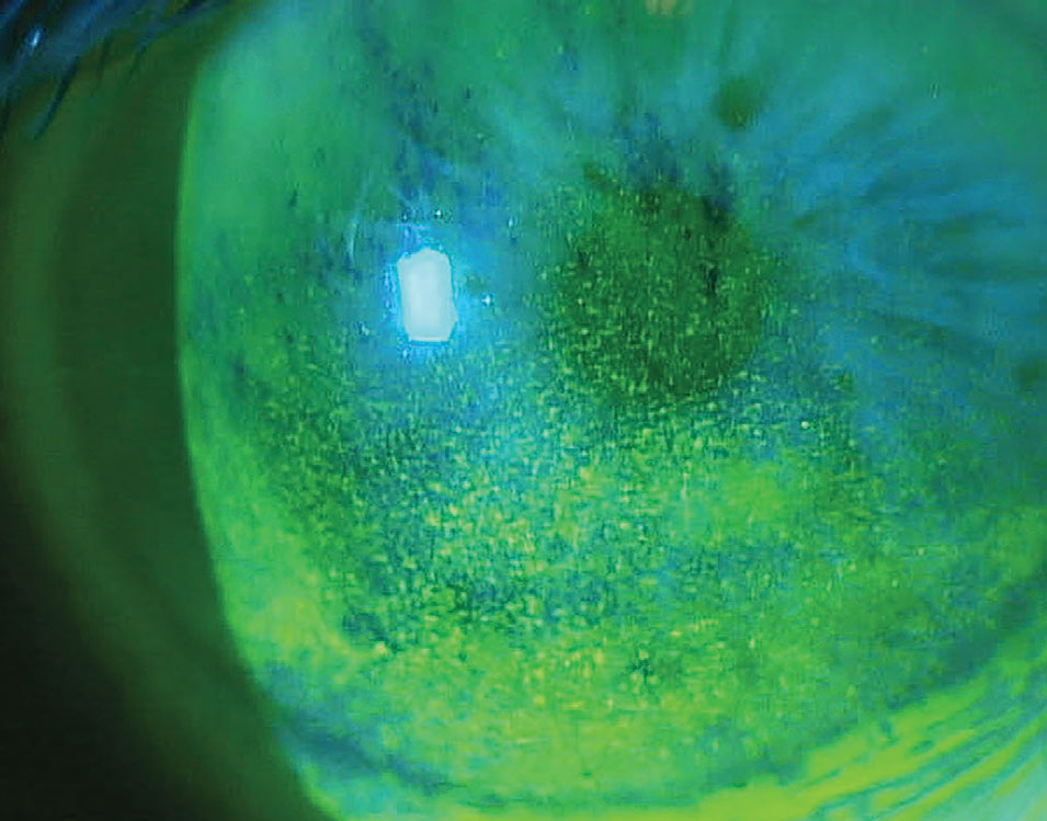 Often, glaucoma medications can cause unwanted ocular surface side effects. Both Iyuzeh and iDose TR are intended to minimize this risk, as neither contain preservatives.