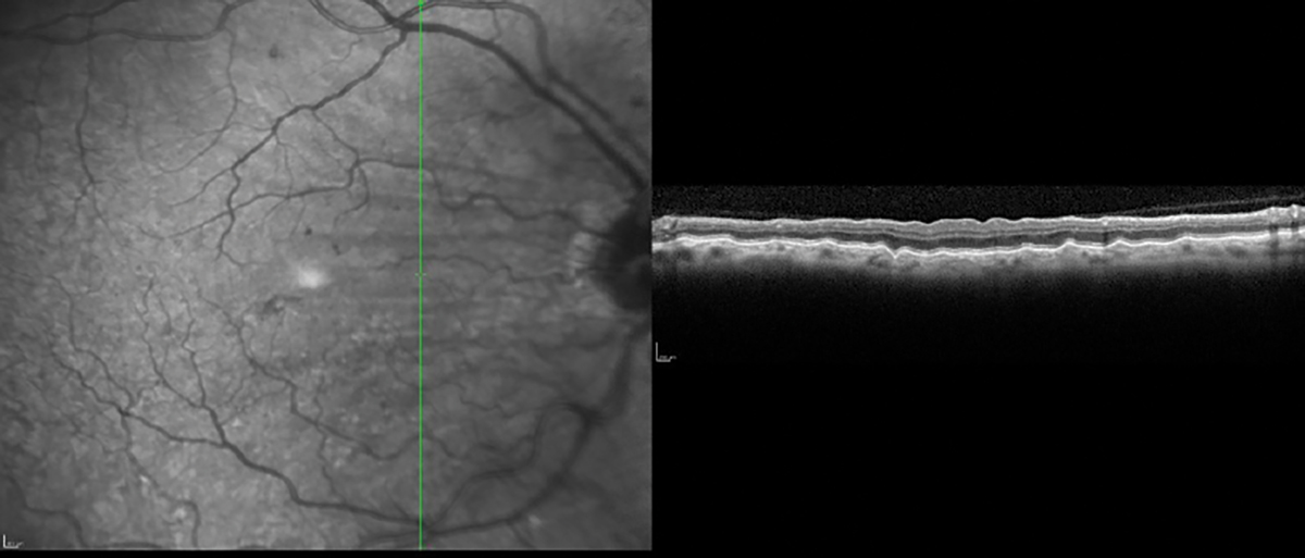 Choroidal folds imaged with high-resolution vertical line scan.