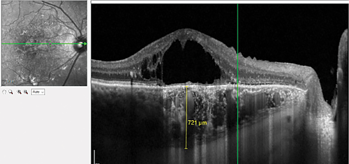 Chronic central serous chorioretinopathy with pachychoroid imaged with EDI OCT. There is a thin choriocapillaris and Sattler’s layer overlying the dilated Haller’s layer.