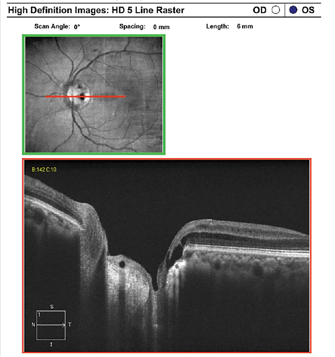 Optic disc pit imaged with EDI OCT. There is a defect in the lamina cribrosa in the temporal optic disc with associated peripapillary retinoschisis.