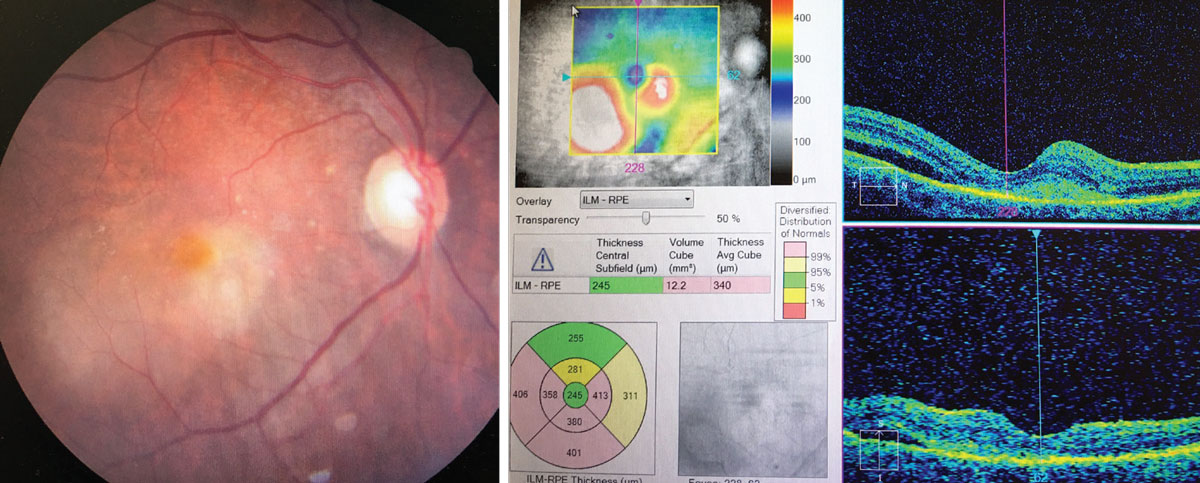 This is the patient’s presentation and OCT. Are there any key findings that align with the patient’s report?