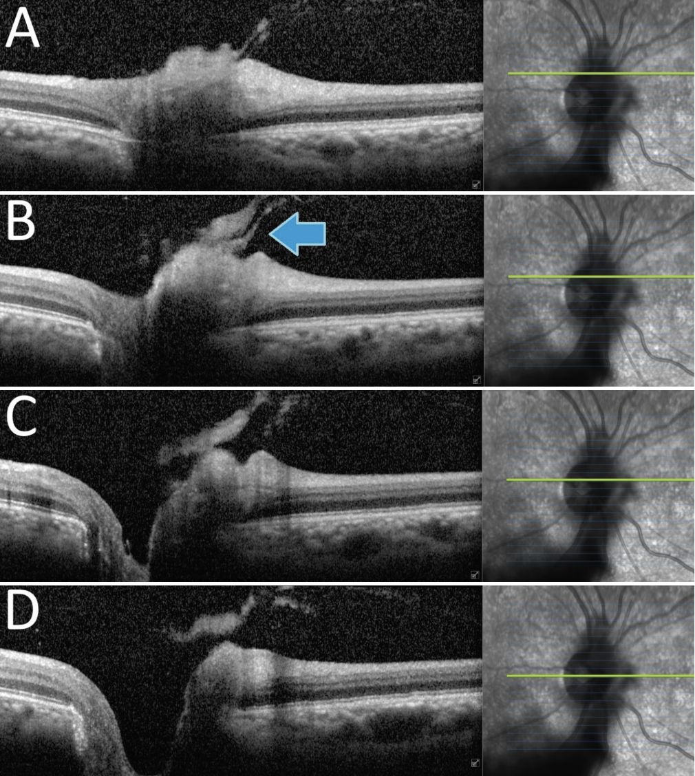 Fig. 3. The raster OCT over the right optic nerve head exhibits vitreous attachment and traction on the superonasal disc margin (arrow). The hyperreflective nature of the posterior hyaloid is likely due to presence of vitreal condensation and/or blood accumulation. 