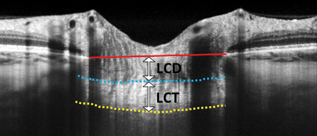 Pre-term kids, especially ones who have undergone ROP treatment, have a higher degree of myopia compared with those born full-term. Several alterations to the lamina cribrosa were also noted in the study.