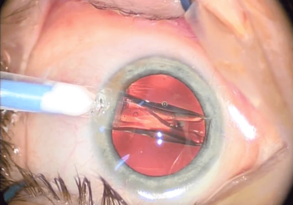 Despite meta-analysis model revealing a reduction of 3.77mm Hg 12 months after phacoemulsification, the certainty of the evidence of this outcome was ranked as very low.