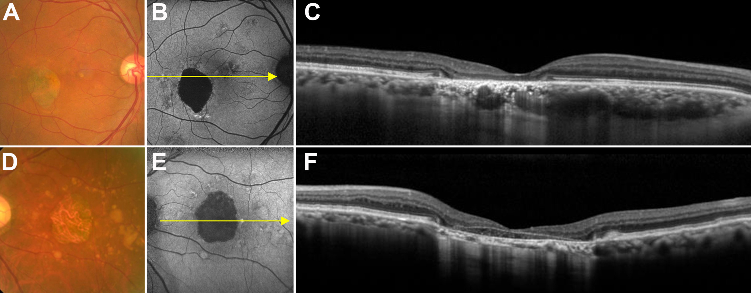 Conventional drusen-related GA observed in Asian populations was similar to that observed in Caucasian populations. These images from the study show multimodal imaging of pachychoroid GA (A–C) and conventional GA (D–F).