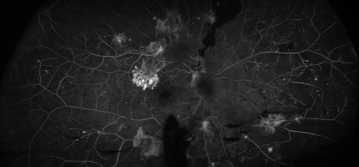 Researchers analyzed parameters such as hyperlipidemia, total cholesterol levels and intraocular pressure and found that results differed significantly based on the presence or absence of carotid stenosis.