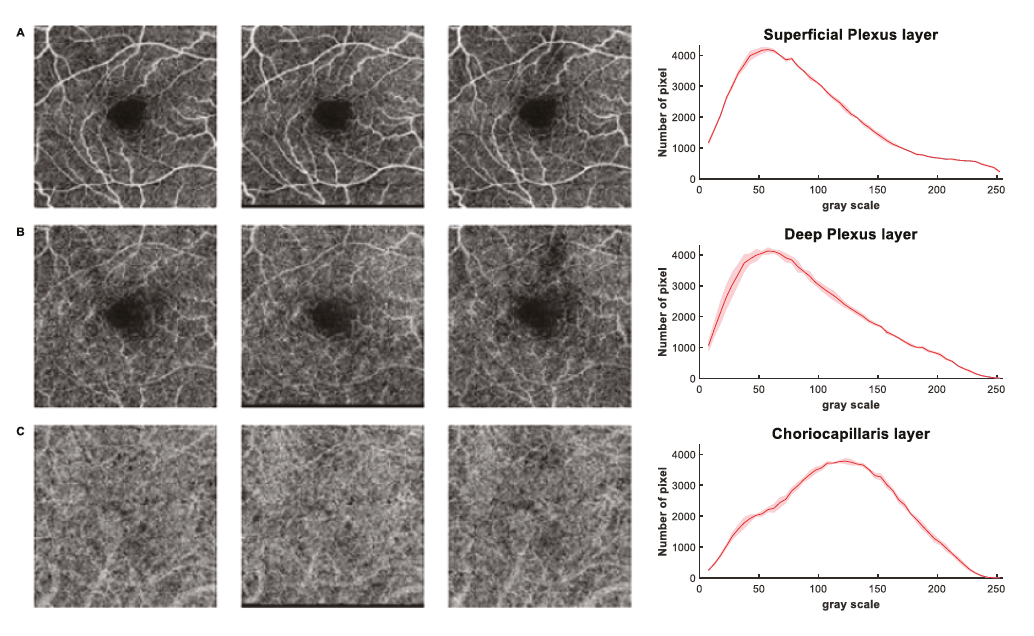 The analysis quantified variations in scans of the same patient and same anatomical site to help uncover blood flow patterns characteristic of glaucoma.