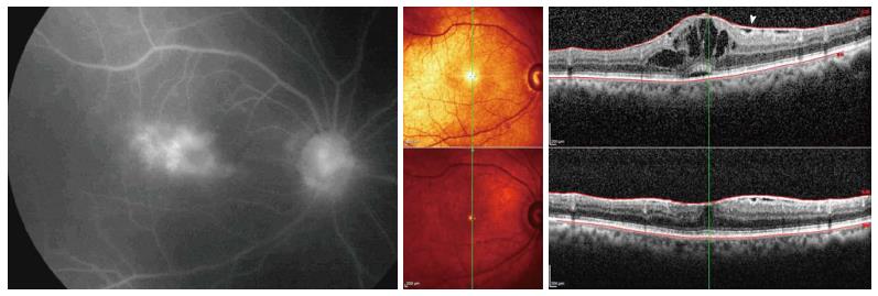 The leading cause of moderate or severe vision loss in uveitis are macular edema and macular scarring often secondary to macular edema. 