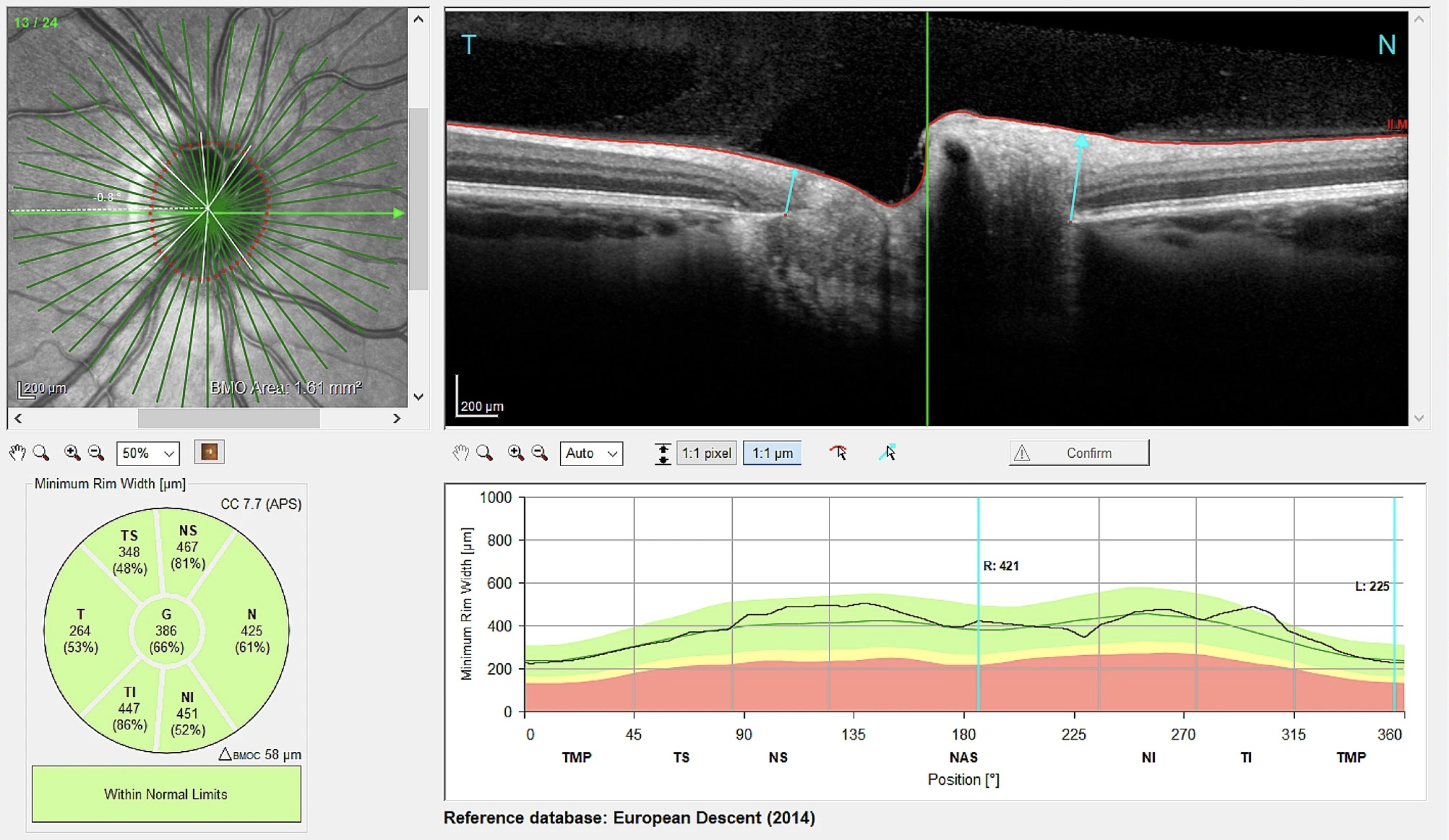 Repeated intravitreal injections due to choroidal neovascularization seem to have a deleterious effect on MRW but not on RNFL. 