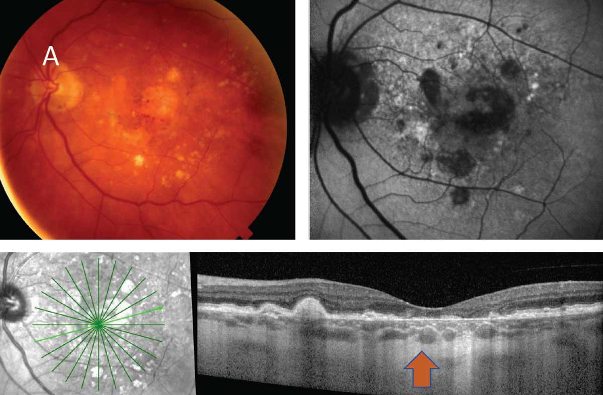 Filtering the shorter wavelengths of light using blue-light filtering IOLs could provide protection against macular atrophy progression.