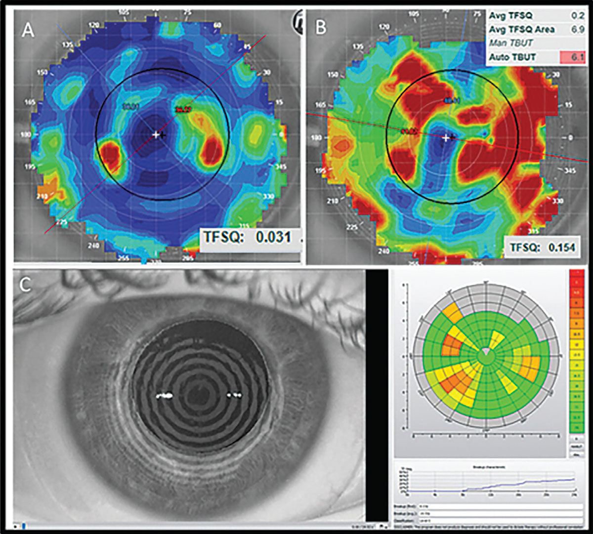 Fig. 1. The top panel shows the tear film quality score display from an E300. The bottom panel is a similar assessment using the keratograph. 