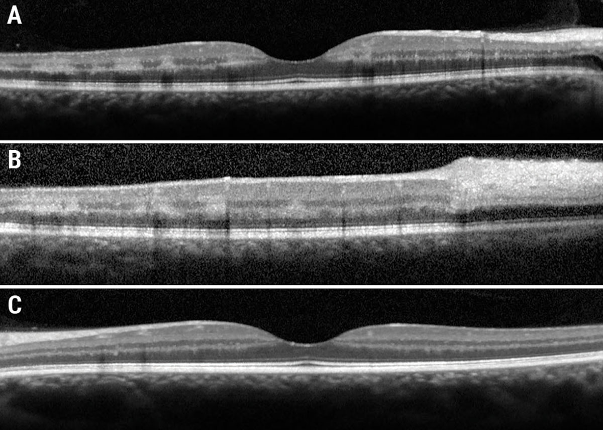 Fig. 2. (a) Foveal OCT OD. (b) Eccentric OCT superior to fovea. (c) Foveal OCT OS.