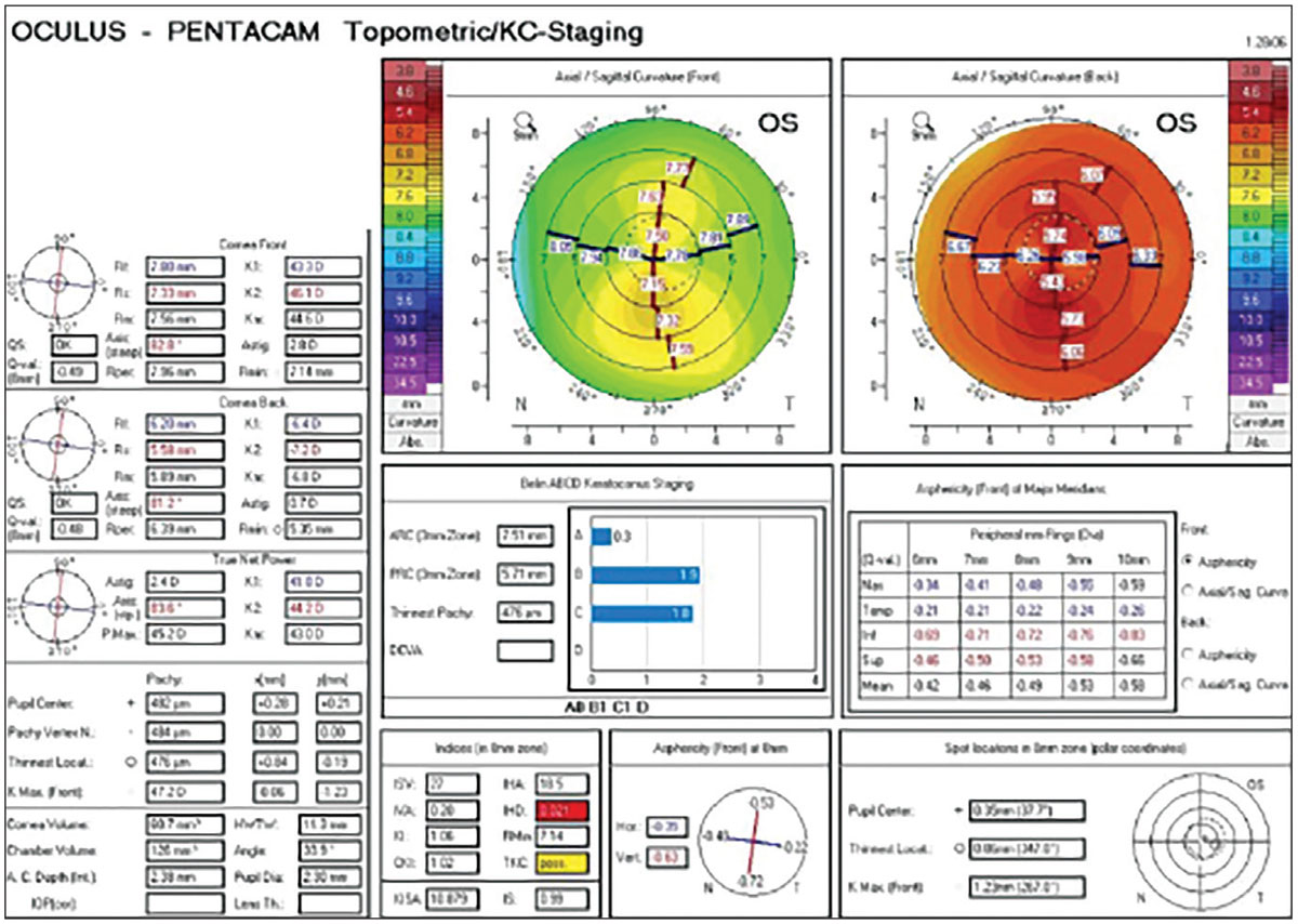 Fig. 5. Pentacam topometric/keratoconus staging OS of a keratoconus suspect.