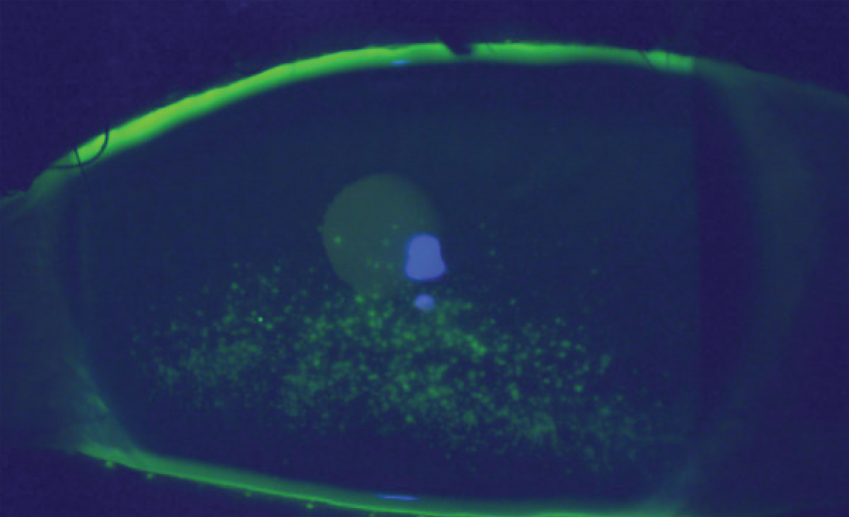 Superficial punctate keratitis in an individual following one infusion of Tivdak.